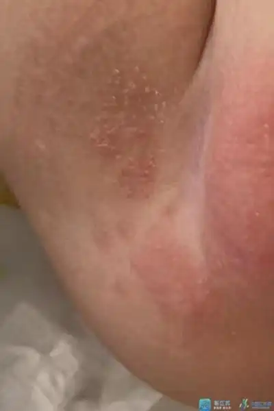 妇幼科普|气温攀升,如何有效防护"红屁股"