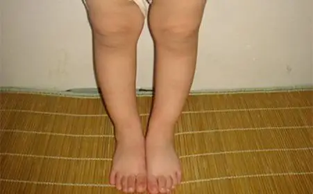 儿科常见病防治之"小儿四病"——营养性维生素d缺乏性佝偻病篇