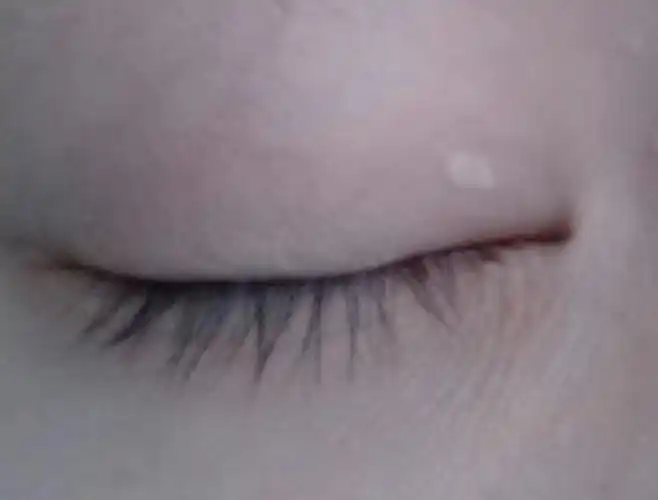 右眼皮上长了一个白色的小肉疙瘩,不痛不痒,怎么办?