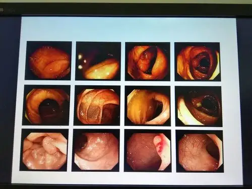 重视肠镜检查警惕其他肛肠疾病