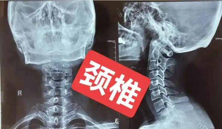 颈椎病的形成.拔罐疾病疗法………颈椎病本病40以上的中老年人 - 抖音