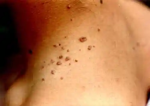 这种肉粒大多数人身上都会出现,学名叫做软纤维瘤,虽然软纤维瘤不会