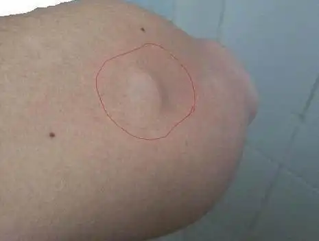 脂肪瘤投保告知吗 脂肪瘤还可以买保险吗