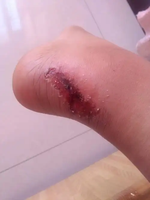 我的脚前天被自行车轱辘绞了,已经肿了.被绞的时候有白色的东西.抹