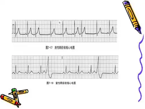 常见异常心电图ppt
