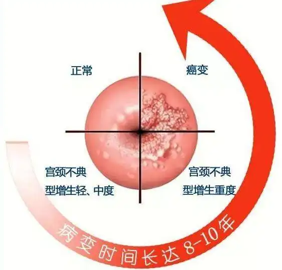 李咏患癌去世这些明星去世也提醒我们hpv感染了盯好这十年