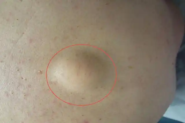 长了脂肪瘤,不痛不痒,但要小心身体这个指标太高