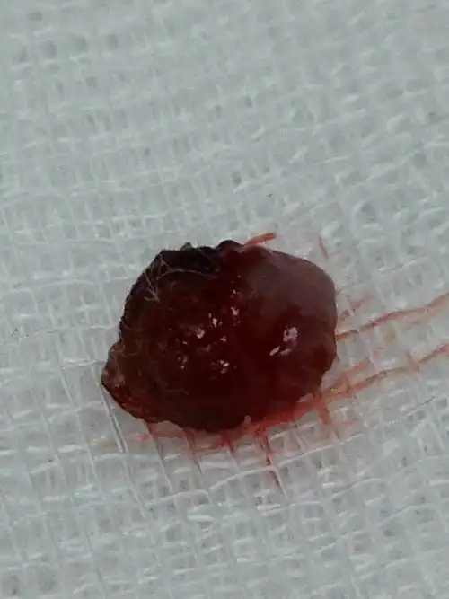 上唇化脓性肉芽肿图片