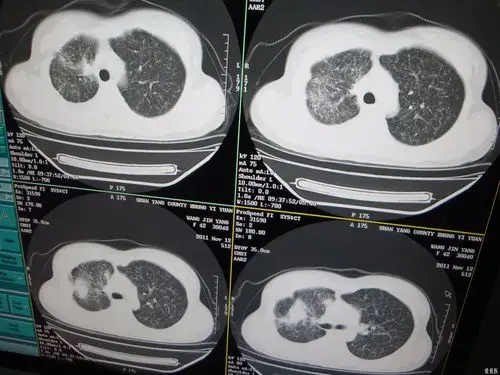 很痛心自行按肺结核治疗3个月复查的胸片