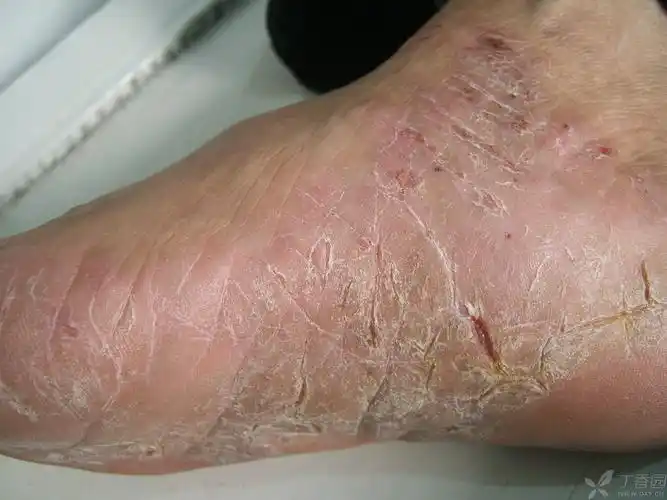 30年病史的-----手脚角化皲裂性湿疹,寻求好治法 - 皮肤性病 -丁香园