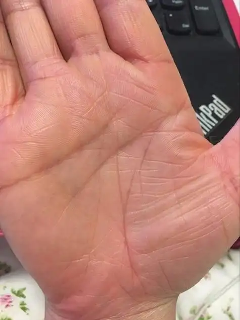 女生左右手生命线断开