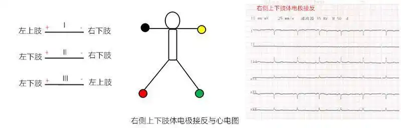 干货肢体导联电极错接的心电图分析及鉴别上四夹子导联