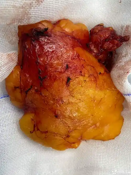 分享图片奖励丁当有趣病例好大一个脂肪瘤