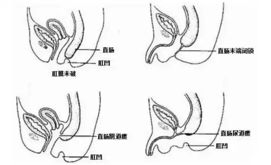 女婴出生无肛门2次手术惊险救回气球宝宝