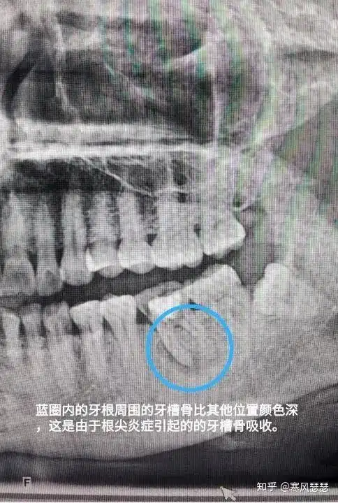 教你读懂自己的口腔x光片
