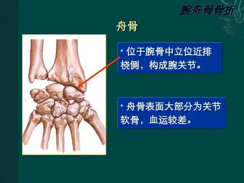 手舟骨骨折ppt