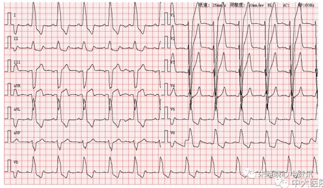 每日读图第1541期完全性左束支传导阻滞