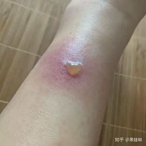 被蚊子咬的包第二天都肿的特别大怎办? - 知乎