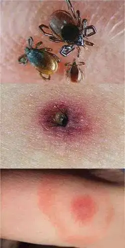 原创亲身经历!夏季不要忽视这5种小虫子的叮咬,有可能会危及生命