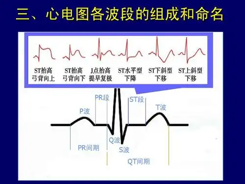 心电图课件ppt
