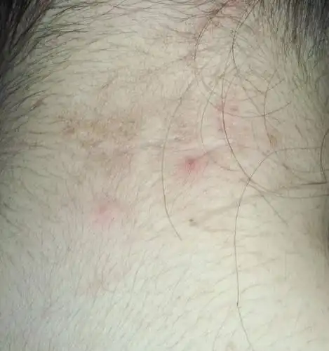 脖子后面的一处皮肤变得皱皱的和棕色的,没有脱落皮屑没有瘙痒疼痛