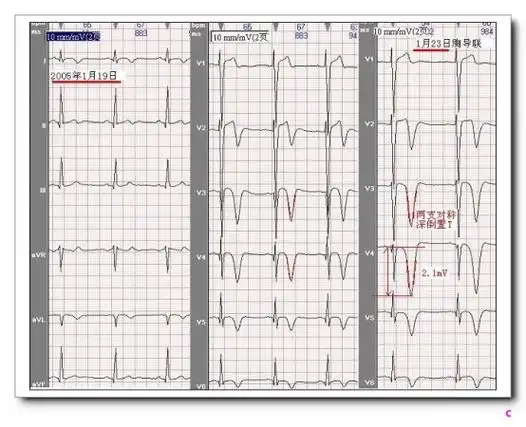 山羊老师课程常见心电图基础知识讲座第十一讲——t波分析