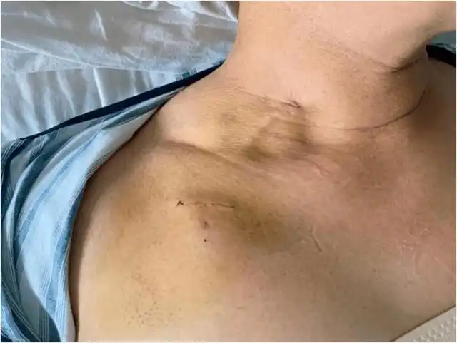 位于胸椎的肿瘤归于骨科专业,位于椎管内的肿