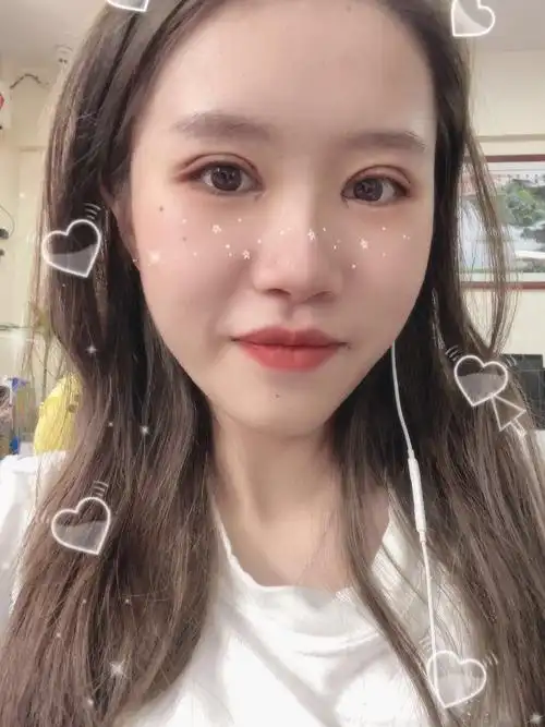 割完双眼皮20天状态