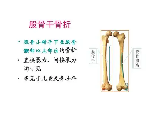 股骨干骨折ppt