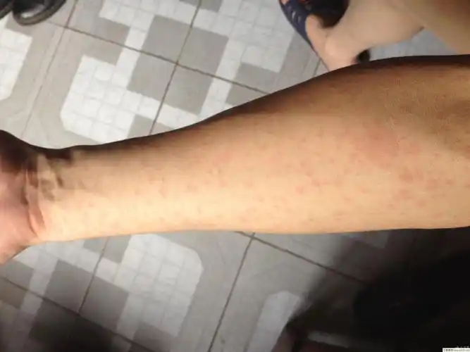 得了风疹该怎么办