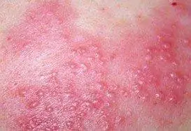 衣物,甚至是马桶等,把单纯生殖器疱疹病毒传染给健康人,这也是引起