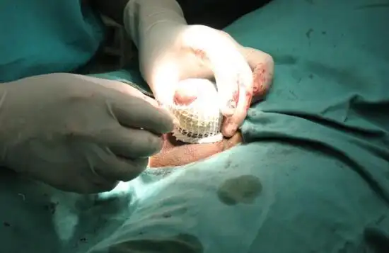 东吴中西医结合医院又完成一例包茎重度粘连松解术