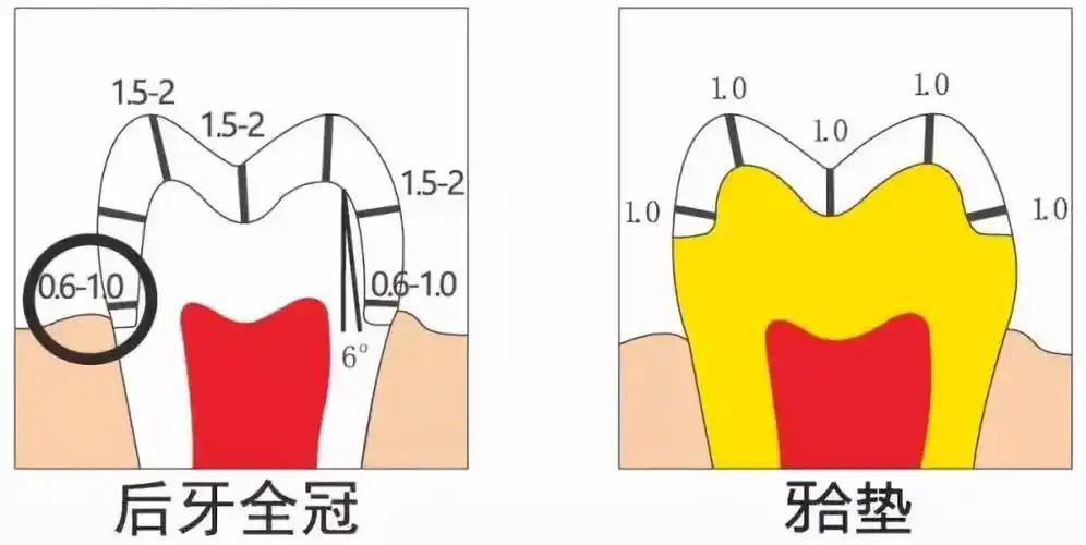 注:各轴面锥度为3°-6°,制备的轴壁要保持光滑.