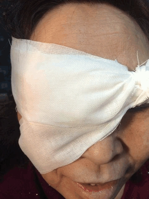 固定棉片加压包扎治疗浅前房