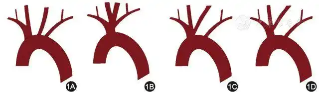 图 1 为主动脉弓畸形类型的示意图:1a 示正常主动脉弓;1b 示真性牛型