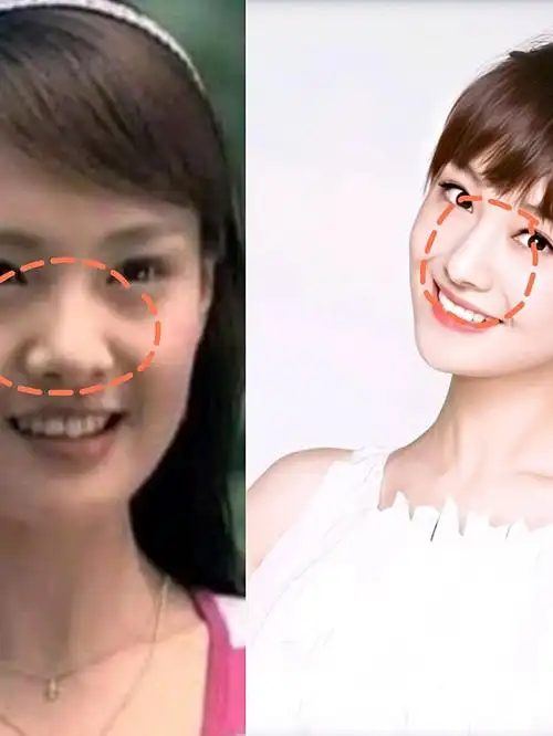 在娱乐圈中整形可以说是家常便饭了,郑爽也曾大方直接承认了自己整容.