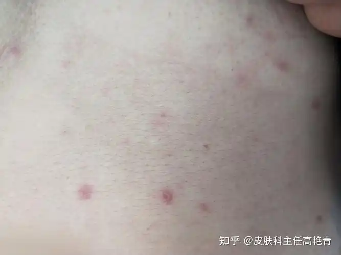 如何判断是否感染梅毒三期梅毒常见症状都有哪些