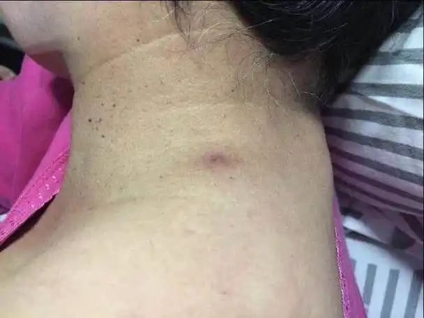 56岁女子被蜱虫咬后钻体内,突发高烧大面积淤血将其抠出时已死