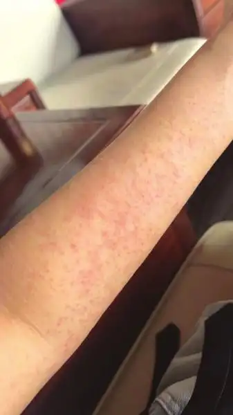 住酒店后四肢长满红疹 医生诊断为屋尘螨过敏,酒店不认可