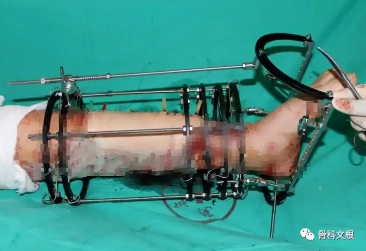 男子严重外伤面临截肢,上海六院文根主任显微手术为其保肢_骨感染病