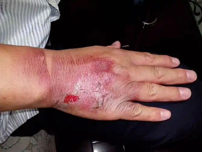 东风日产阳光安全气囊炸伤人销售商认为正常