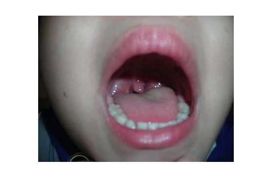 3岁宝宝扁桃体肥大应该如何治疗问答