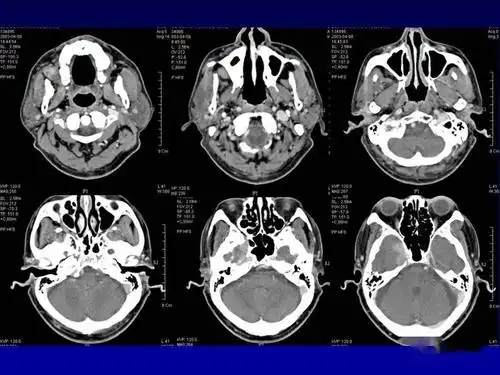 颌面部解剖及其病变的影像诊断