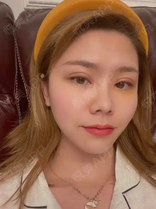 眼综合整形术后7天_全切双眼皮术后7天_眼综合术后7天_双眼皮术后7天