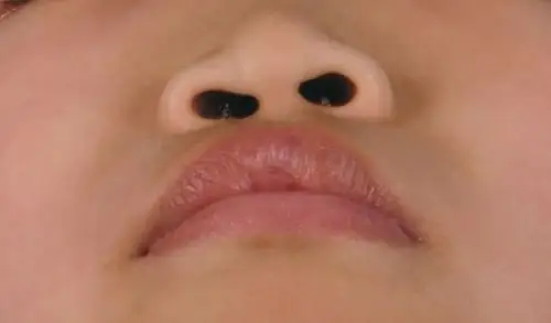 唇裂及唇裂鼻畸形如何手术治疗?