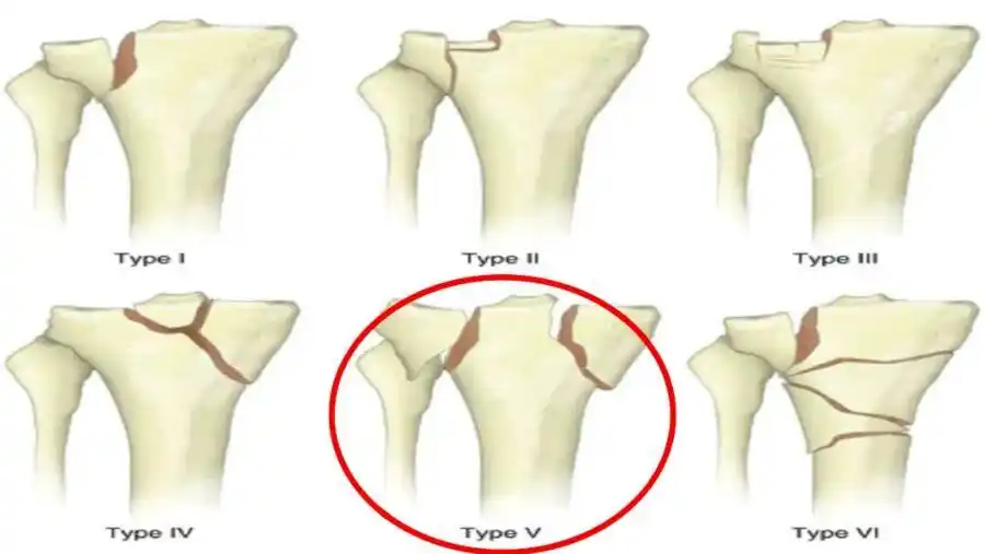胫骨平台骨折的schatzker分型