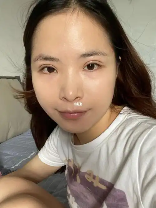 全切双眼皮第十天啦_全切双眼皮_双眼皮手术_美妆_医美整形