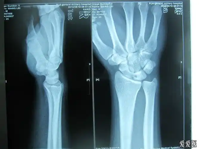 临床上月状骨受伤引起缺血性坏死的经典病例 请各位老师支招