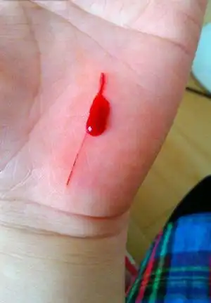 手出血的图片 (42)_有来医生