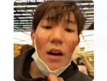 王源的脸上长满了痘痘,看起来就像月球的表面一样坑坑洼洼,与大家平时